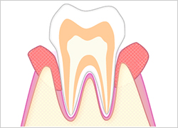中度の歯周病|あさみ歯科クリニック
