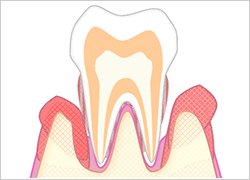重度の歯周病|あさみ歯科クリニック